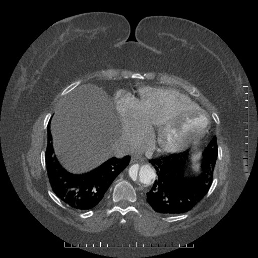Aortic dissection- Stanford A (Radiopaedia 35729-37268 B 9).jpg