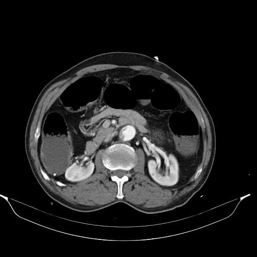 Aortic dissection- Stanford type A (Radiopaedia 22085-22085 A 48).jpg