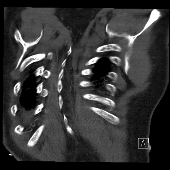 Aortic dissection (CTPA) (Radiopaedia 75506-86750 B 68).jpg
