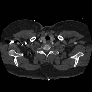 Aortic dissection (Radiopaedia 57969-64959 A 17).jpg
