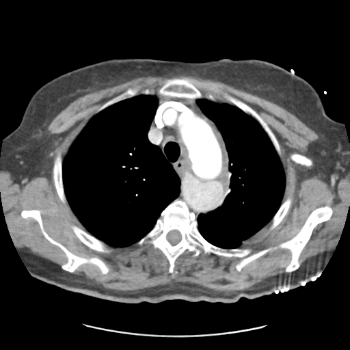 File:Aortic dissection - Stanford type B (Radiopaedia 50171-55512 A 12).png