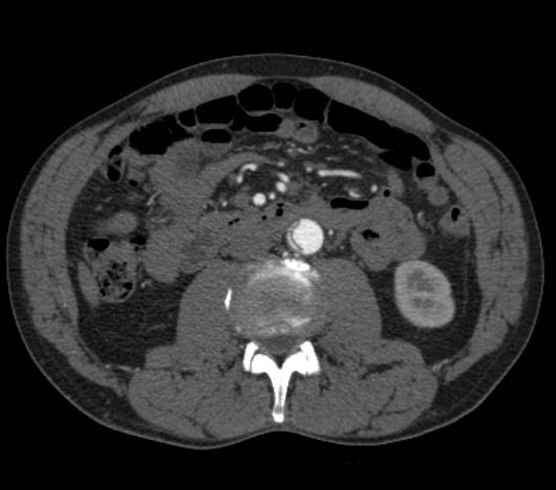 Aortic dissection - Stanford type B (Radiopaedia 73648-84437 A 164).jpg