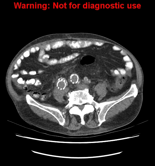 Aortic graft infection (Radiopaedia 44979-48907 Axial non-contrast 64).jpg