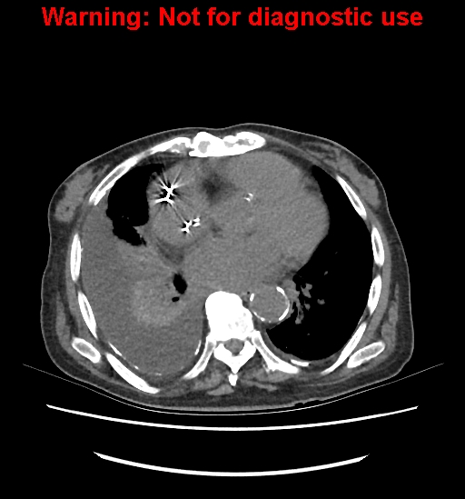 Aortic graft infection (Radiopaedia 44979-48907 Axial non-contrast 7).jpg
