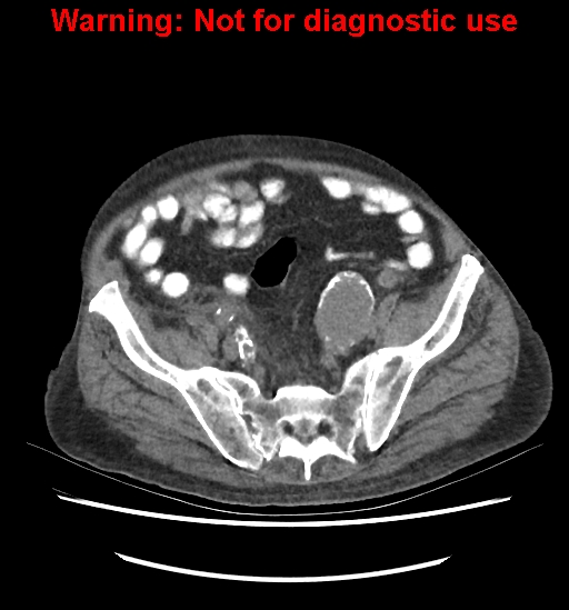 Aortic graft infection (Radiopaedia 44979-48907 Axial non-contrast 74).jpg