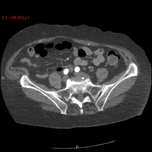 File:Aortic intramural hematoma (Radiopaedia 27746-28001 A 149).jpg