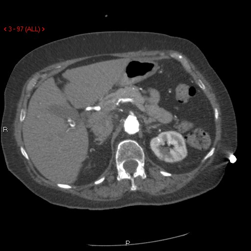 File:Aortic intramural hematoma (Radiopaedia 27746-28001 A 97).jpg