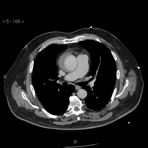 Aortic intramural hematoma (Radiopaedia 48463-53380 C 76).jpg