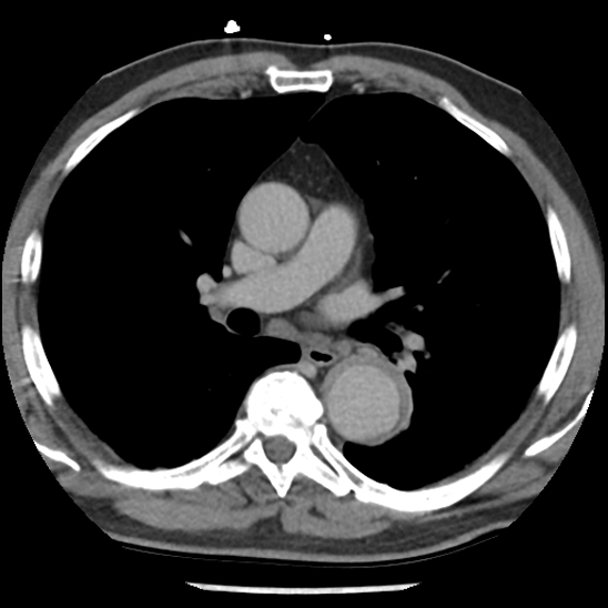 Aortic intramural hematoma (type B) (Radiopaedia 79323-92387 Axial C+ delayed 24).jpg