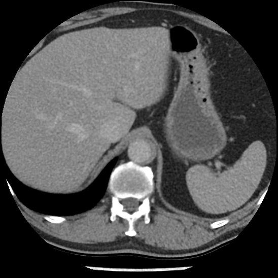 Aortic intramural hematoma (type B) (Radiopaedia 79323-92387 Axial C+ delayed 52).jpg