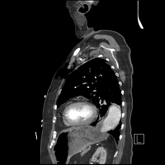 File:Aortic intramural hematoma with dissection and intramural blood pool (Radiopaedia 77373-89491 D 64).jpg