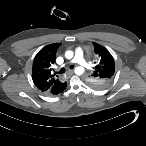 Aortic transection, diaphragmatic rupture and hemoperitoneum in a complex multitrauma patient (Radiopaedia 31701-32622 A 35).jpg