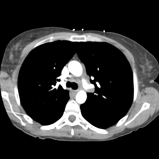 Aortic valve non-coronary cusp thrombus (Radiopaedia 55661-62189 B 18).png