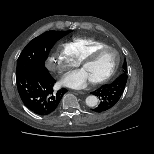File:Aorto-coronary bypass graft aneurysms (Radiopaedia 40562-43157 A 82).png