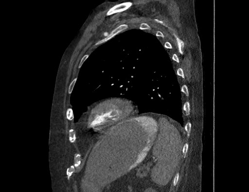 Aortoesophageal fistula with endovascular repair (Radiopaedia 73781-84592 Sagittal C+ CTPA 155).jpg