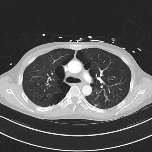 Apical bullous disease in a heavy smoker (Radiopaedia 33067-34092 Axial lung window 24).png