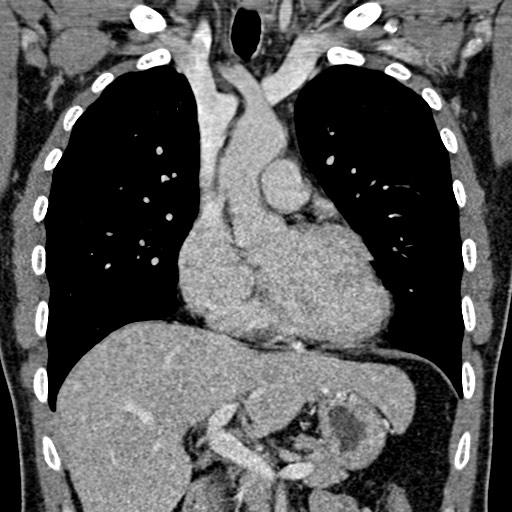 Apical lung mass mimic - neurogenic tumor (Radiopaedia 59918-67521 B 55).jpg