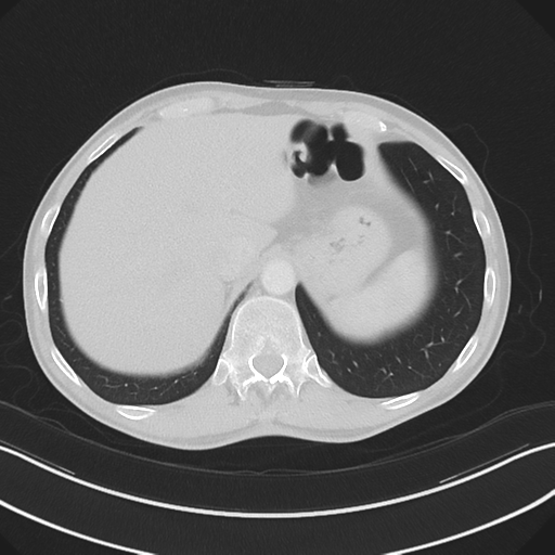 Apical pleural calcification (Radiopaedia 46141-50499 Axial lung window 63).png