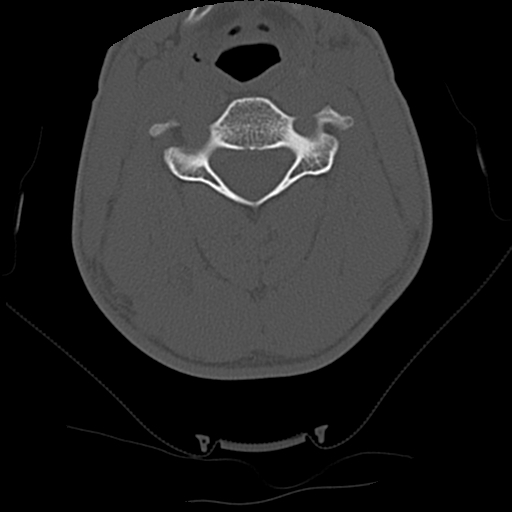File:Apical pneumothorax on cervical spine CT (Radiopaedia 45343-49368 Axial bone window 43).jpg