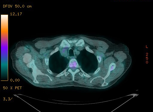 Appendiceal adenocarcinoma complicated by retroperitoneal abscess (Radiopaedia 58007-65041 Axial PET-CT 39).jpg