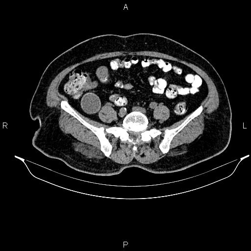 Appendiceal mucocele (Radiopaedia 82952-97298 A 72).jpg