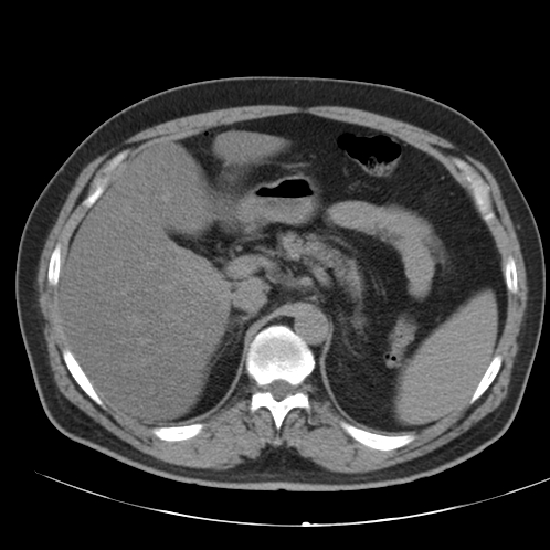 Appendicitis and giant appendicolith (Radiopaedia 80251-93588 Axial non-contrast 11).jpg