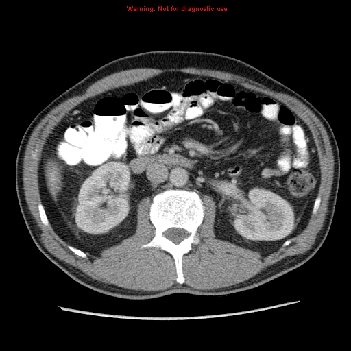 File:Appendicitis and renal cell carcinoma (Radiopaedia 17063-16760 A 24).jpg