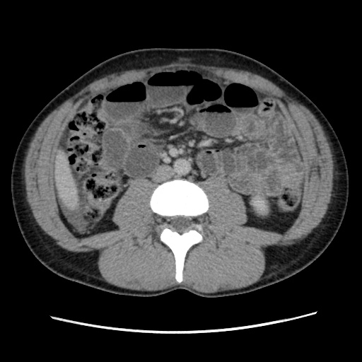 File:Appendicitis complicated by post-operative collection (Radiopaedia 35595-37114 A 45).jpg