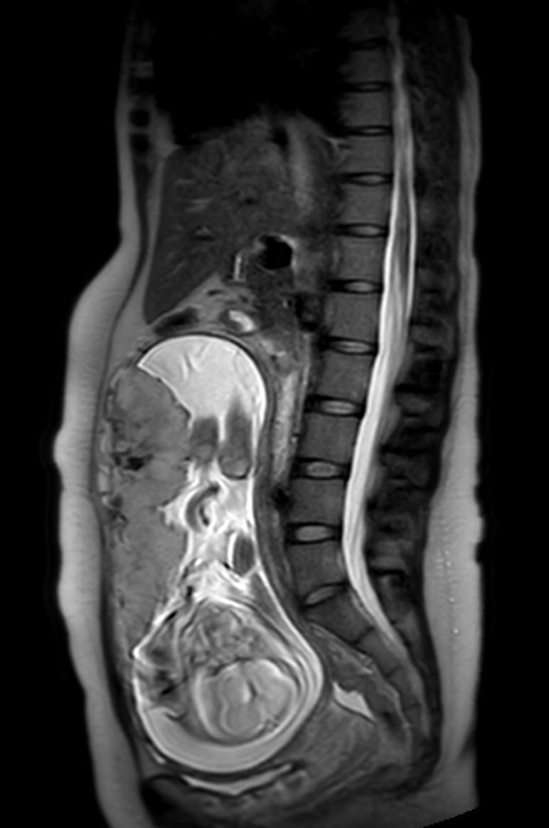Appendicitis in gravida (MRI) (Radiopaedia 89433-106395 Sagittal T2 34).jpg