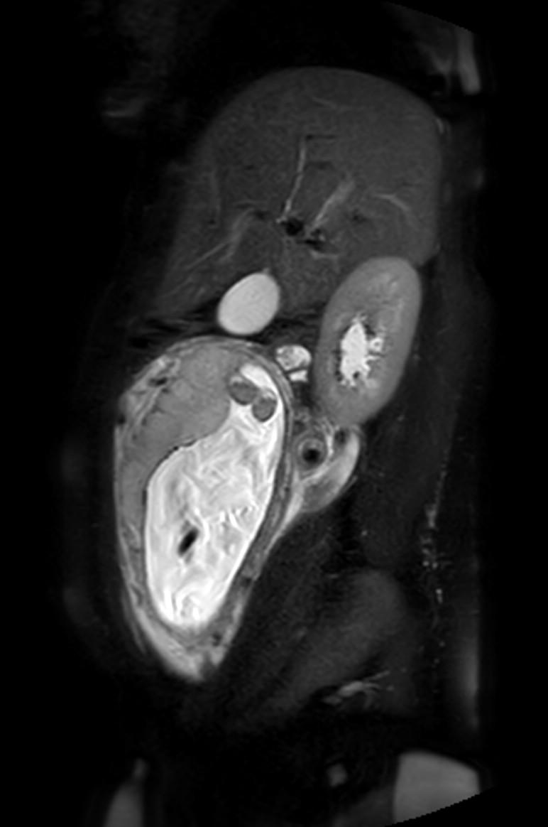 Appendicitis in gravida (MRI) (Radiopaedia 89433-106395 Sagittal T2 SPAIR 44).jpg