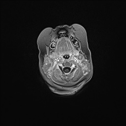 Aqueductal stenosis (Radiopaedia 73974-84802 Axial T1 C+ 22).jpg