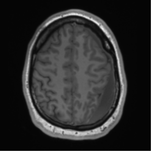 File:Arachnoid cyst with subdural hematoma (Radiopaedia 85892-101743 Axial T1 66).png