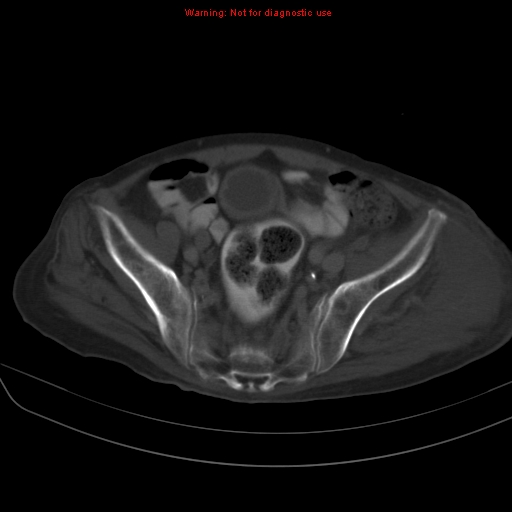 File:Arachnoiditis ossificans (Radiopaedia 51394-57136 Axial bone window 36).jpg