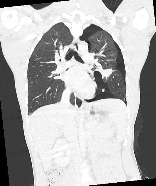 Arrow injury to the chest (Radiopaedia 85367-100975 Coronal lung window 78).jpg