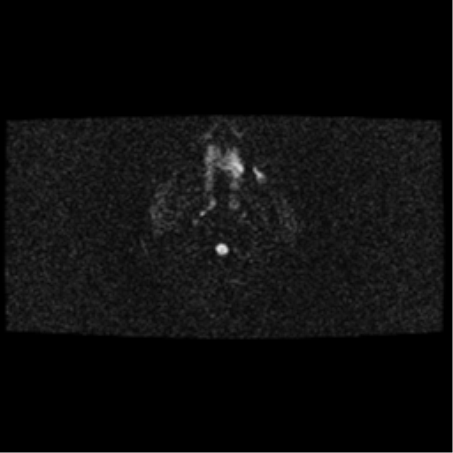 File:Arteriovenous malformation (cerebral) (Radiopaedia 40070-42580 Axial DWI 1).png