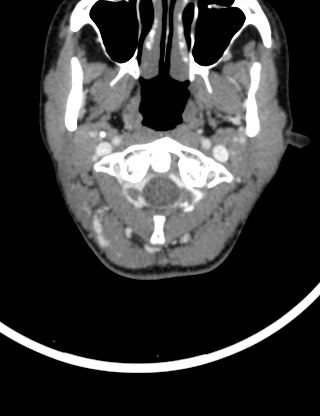 File:Arteriovenous malformation of the neck (Radiopaedia 53935-60062 B 6).jpg