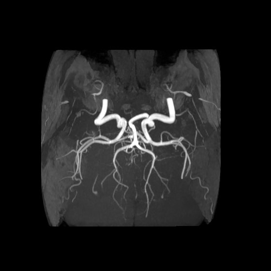 Artery of Percheron infarct (Radiopaedia 40966-43676 F 47).jpg