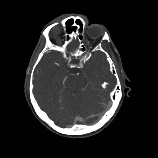 File:Artery of Percheron infarct (Radiopaedia 48088-52894 A 125).jpg