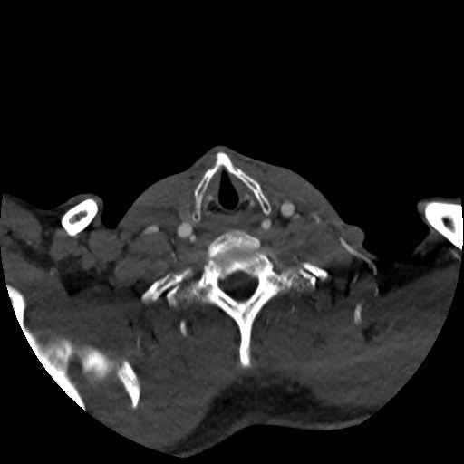 File:Artery of Percheron infarct (Radiopaedia 48088-52894 A 42).jpg