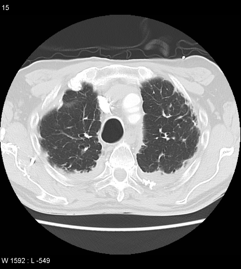 Asbestos related lung and pleural disease (Radiopaedia 14377-14301 A 12).jpg