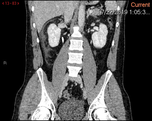 File:Ascending colonic diverticulum mimicking acute appendicitis (Radiopaedia 69943-80198 B 83).jpg
