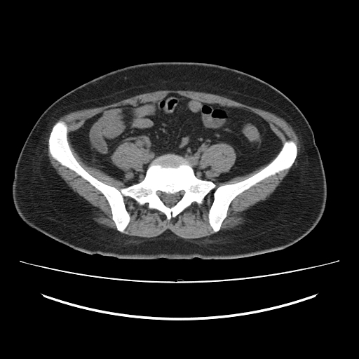 Ascending retrocecal appendicitis with liver abscesses (Radiopaedia 60066-67615 Axial non-contrast 61).jpg