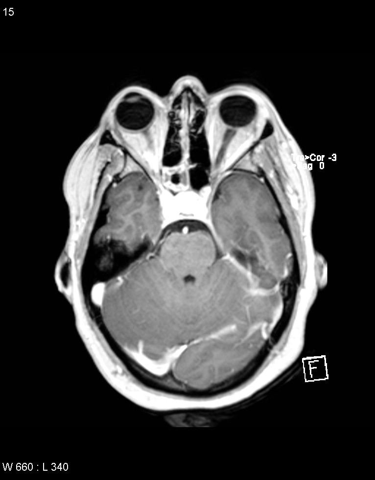Astroblastoma (Radiopaedia 39792-42218 Axial T1 C+ 14).jpg