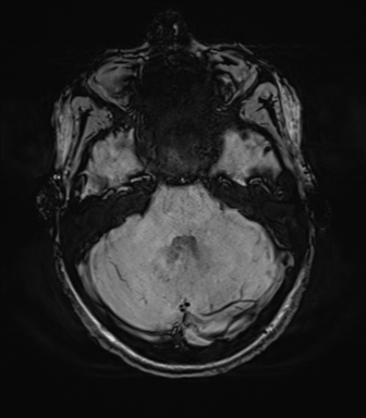 File:Astrocytoma, IDH-mutant - grade 3 (Radiopaedia 50046-55341 Axial 303).png