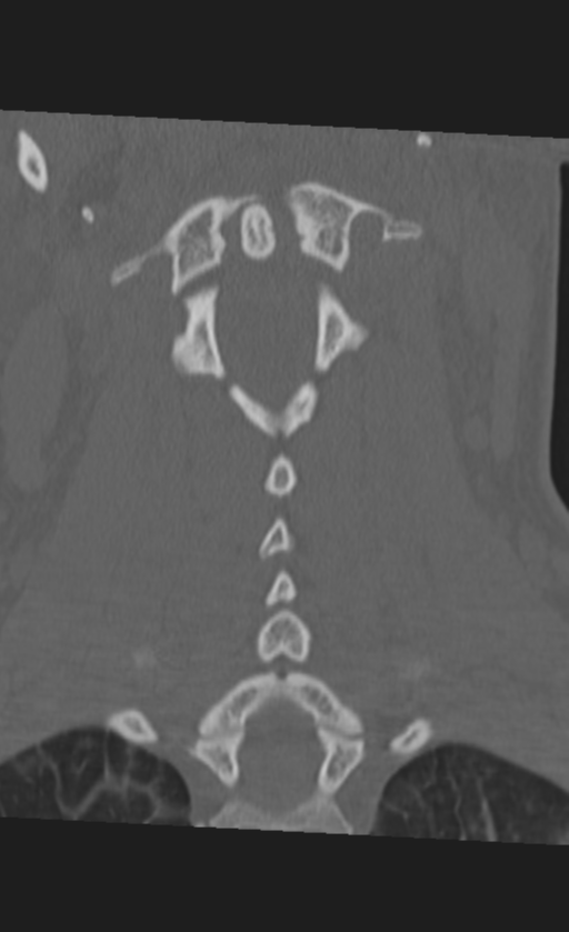 Atlanto-occipital dissociation (Radiopaedia 33848-35013 Coronal bone window 28).png