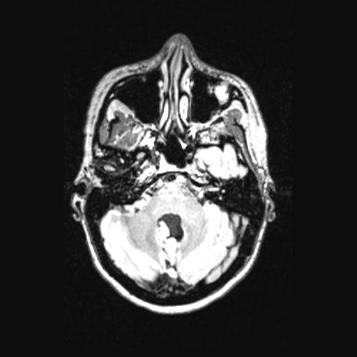 Atretic encephalocoele with inferior vermis hypoplasia (Radiopaedia 30443-31108 Axial 44).jpg