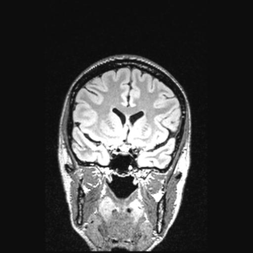Atretic encephalocoele with inferior vermis hypoplasia (Radiopaedia 30443-31108 Coronal FLAIR 121).jpg