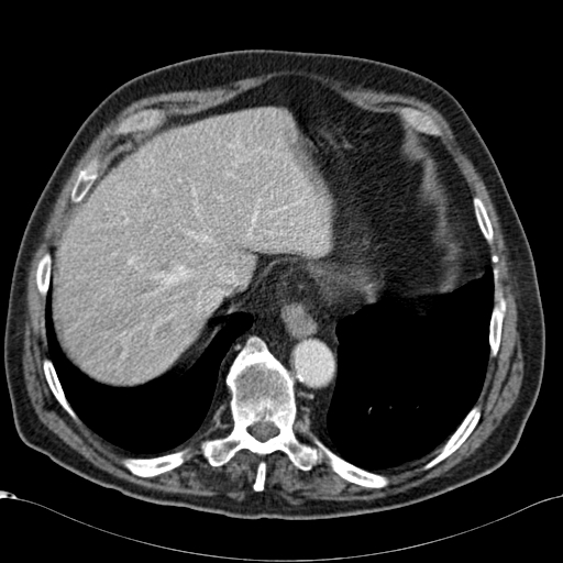 Atypical hepatocellular carcinoma (Radiopaedia 41744-44698 B 13).jpg