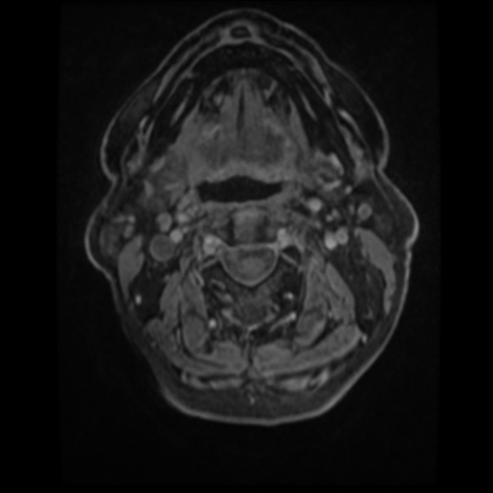 Atypical meningioma (Radiopaedia 45535-49629 Axial T1 C+ 3).jpg