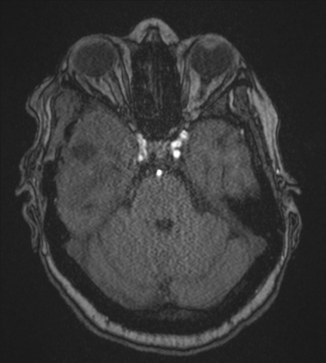 Atypical meningioma (WHO Grade II) (Radiopaedia 54742-60981 Axial MRA 30).png
